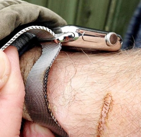 Apple Watch poparzył starszego mężczyznę