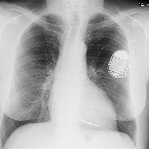 Programowalne rozruszniki serca podatne na ataki hakerów