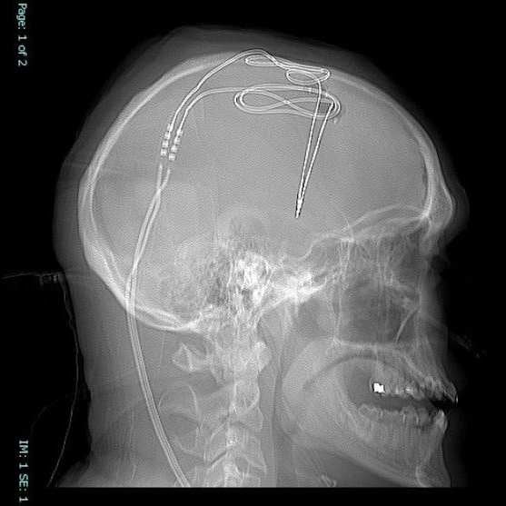 Implant mózgowy zwalczy uzależnienie od narkotyków