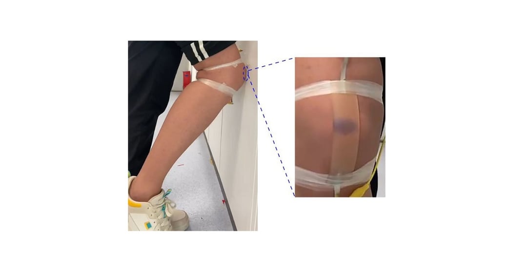 Na sztucznej skórze pojawią się siniaki. Jak może nam to pomóc?