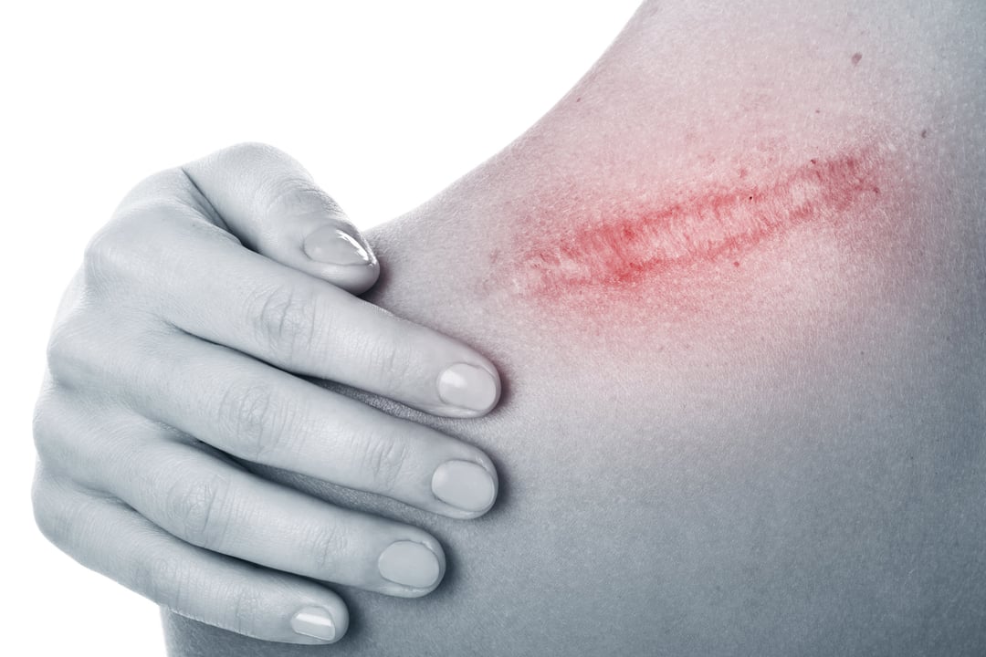 Klej chirurgiczny zainspirowany wąsonogami zatrzyma krwawienie w ciągu 30 sekund