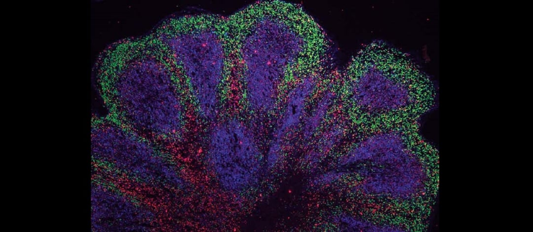 Wyhodowali mini-mózgi. Teraz chcą z ich wykorzystaniem leczyć śmiertelną chorobę