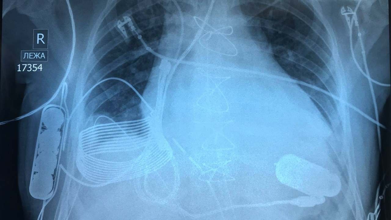 Pierwsze bioniczne serce ładowane bezprzewodowo