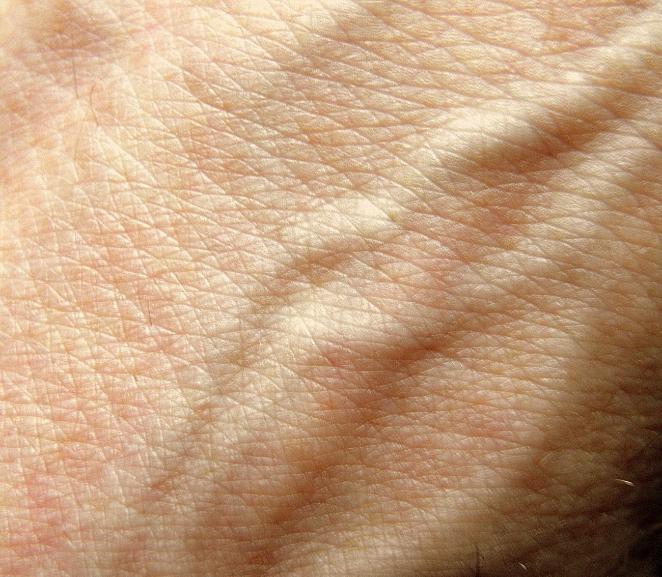 Google stworzyło aplikację, która może rozpoznać 288 chorób skóry