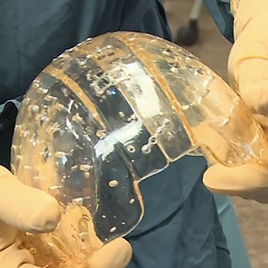 W Holandii wszczepiono czaszkę wydrukowaną w 3D
